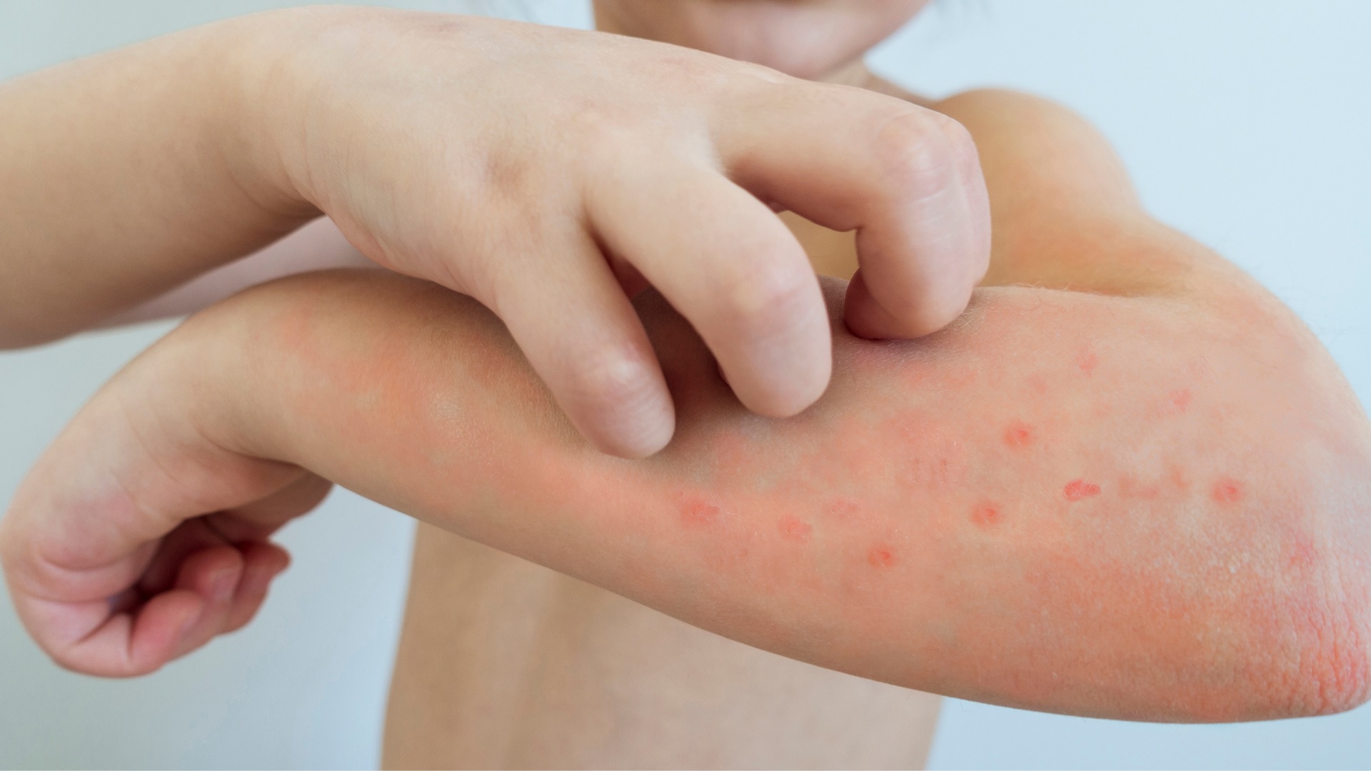 Chickenpox is spreading rapidly in Kerala so many cases have been reported