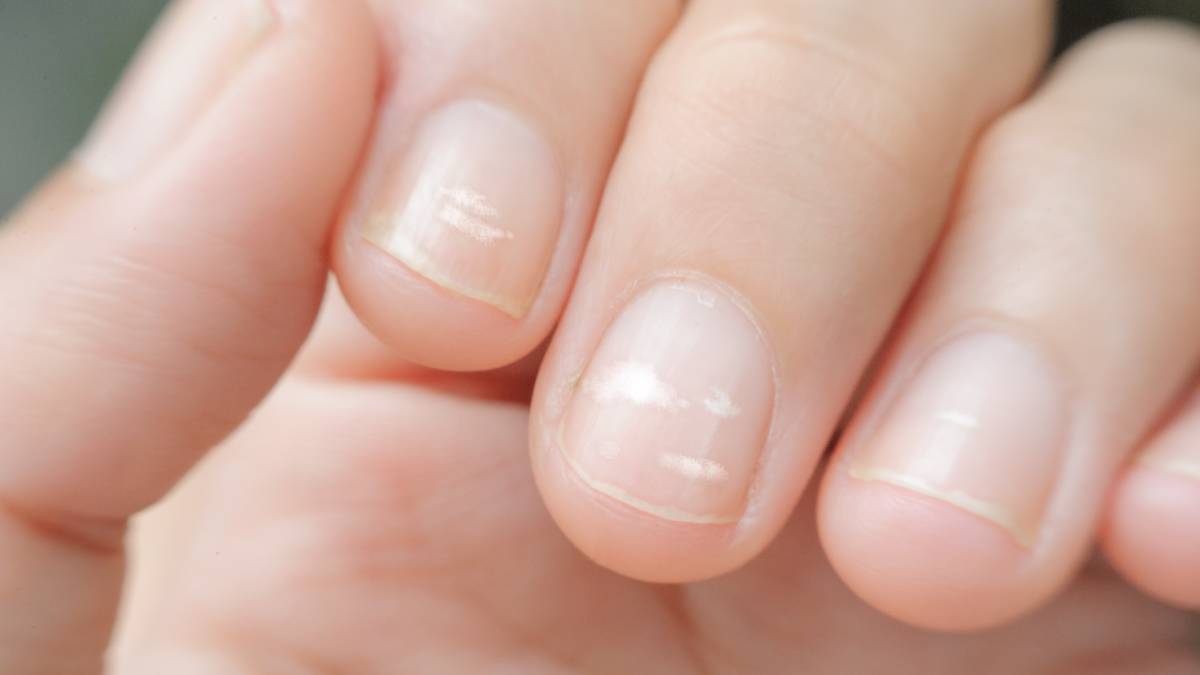 White Spots on Nails This disease in the body causes white marks on nails 1