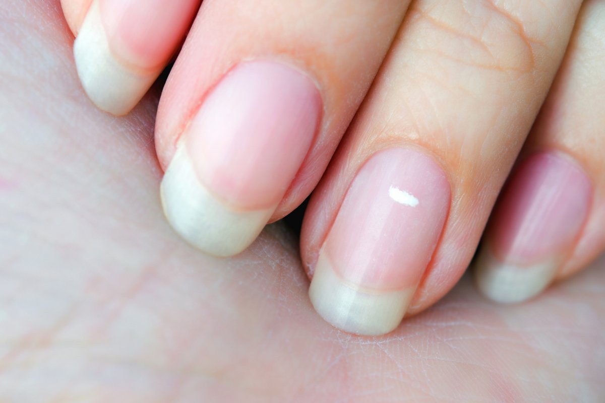 White Spots on Nails This disease in the body causes white marks on nails 2