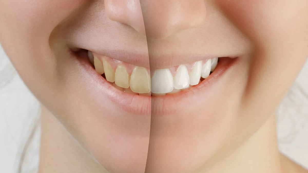 If yellow teeth have robbed you of your smile get shiny teeth with these remedies 1