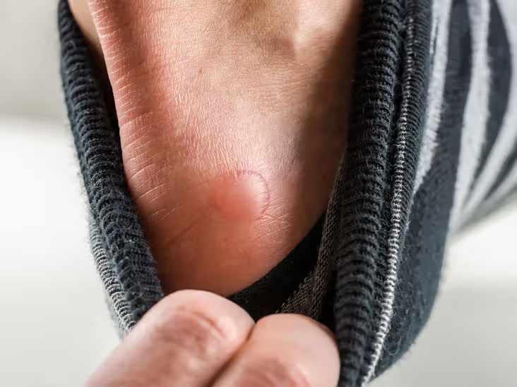 do you also get frequent blisters so dont take it lightly these five serious illnesses can happen 2