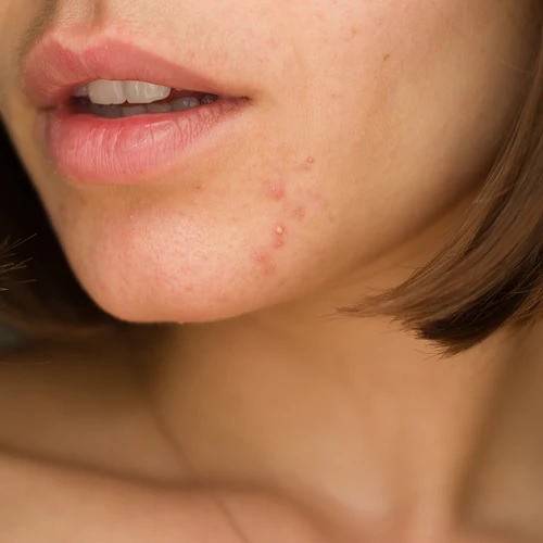 how to remove pimples naturally and permanently home remedies for acne 2