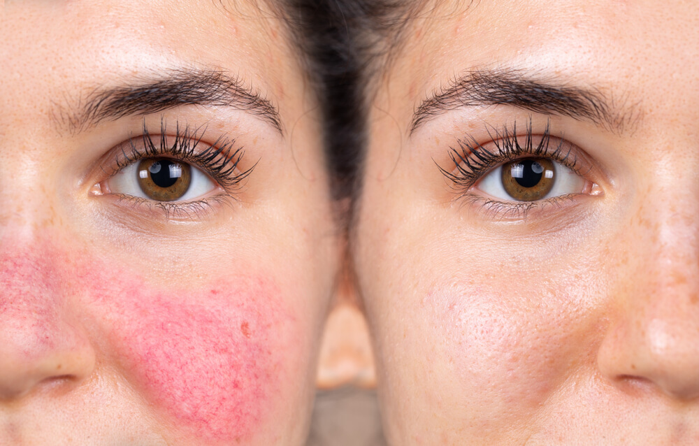 Before and after successful rosacea treatment