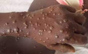 mpox monkeypox virus cases india prepares threat hospital airports alert