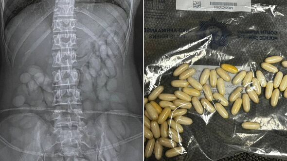 woman arrested in brazil from airport x ray scaning reveal 60 cocaine bullets in stomach