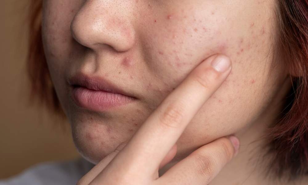 if you are troubled by acne and pimples in winter get rid of them1