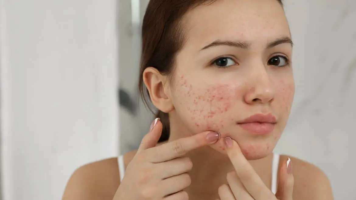 if you are troubled by acne and pimples in winter get rid of them2