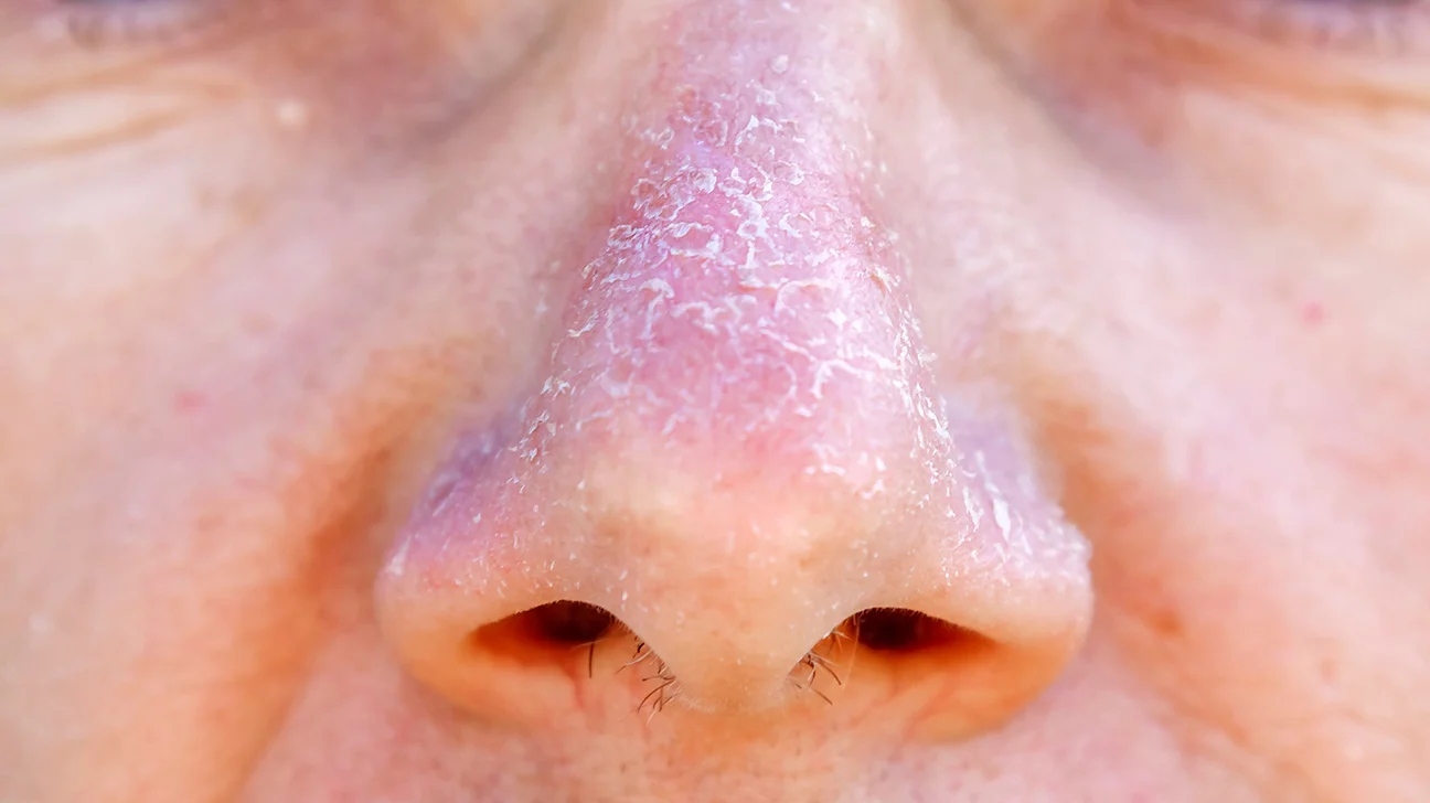 follow these tips to cure peeling skin around the nose due to cold ewr