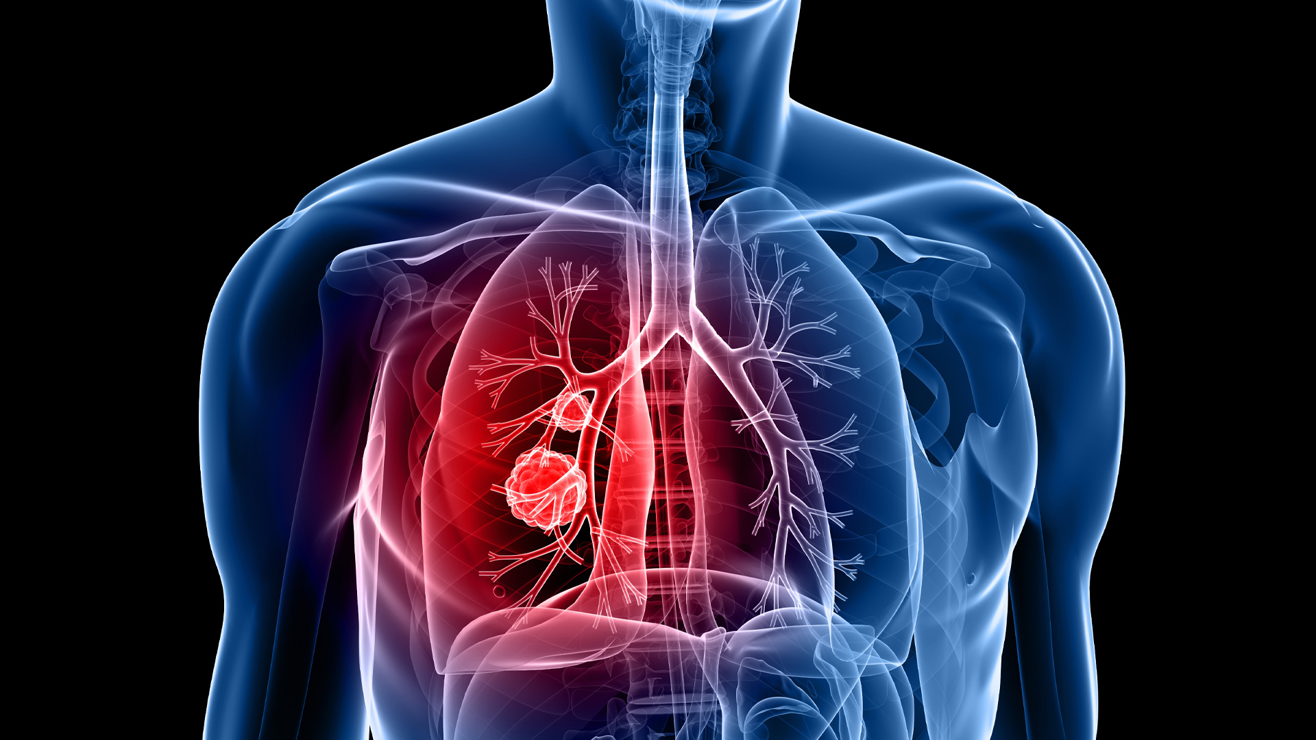 what is difference between lung cancer and lung tumor know symptoms1