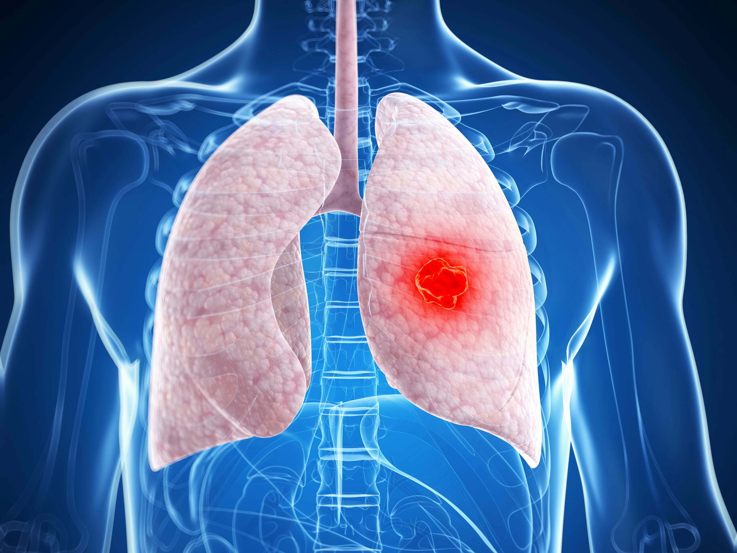 what is difference between lung cancer and lung tumor know symptoms2