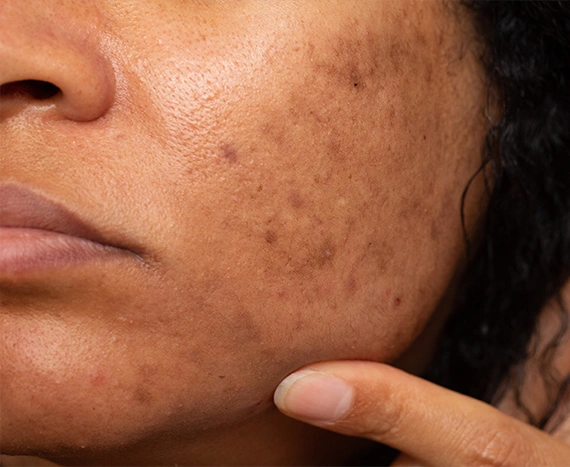 what is the problem of hyperpigmentation know from experts how to get rid of itey45y7