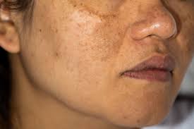 what is the problem of hyperpigmentation know from experts how to get rid of itty547